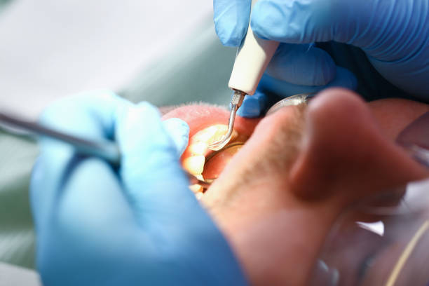 Best Emergency Root Canal Treatment in Marionville, MO